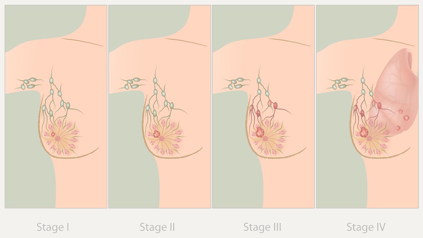 Bone Cancer treatment in India